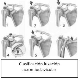 Clasificación Luxación Acromioclavicular