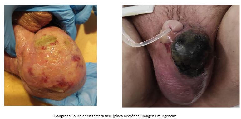 Gangrena Fournier en tercera fase