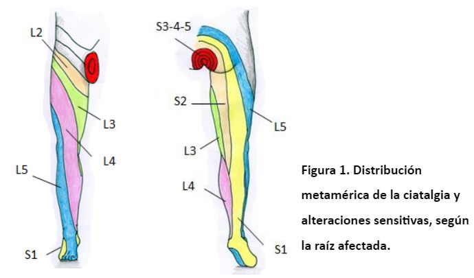 distribución ciatalgia