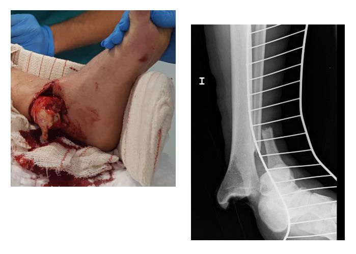 fractura abierta