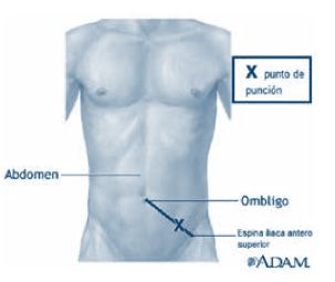 paracentesis técnica