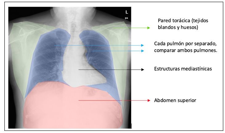 rx patología torácica