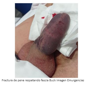 Fractura Pene