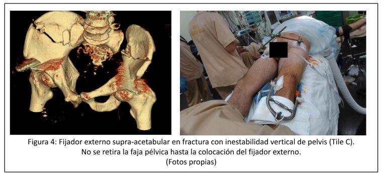 Fijador externo