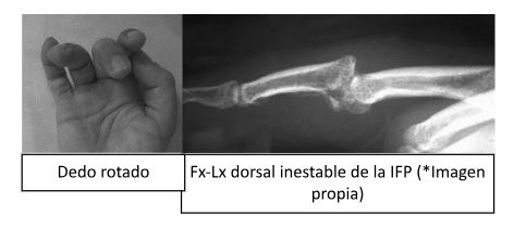 Fractura dorsal inestable