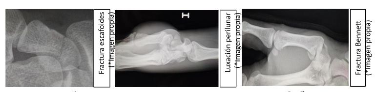 Fractura escafoides