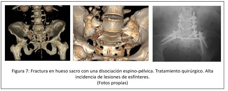Fractura hueso sacro
