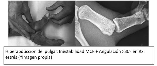 Hiperabducción del pulgar