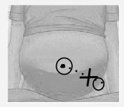 Paracentesis evacuadora
