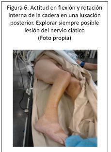Rotación y Flexión interna de cadera