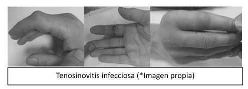Tenosinovitis infecciosa