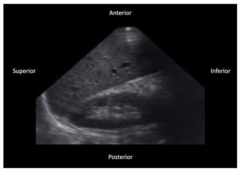eco plano coronal