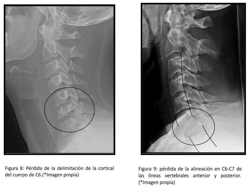 ejemplo radiografías fracturas c cervical 2