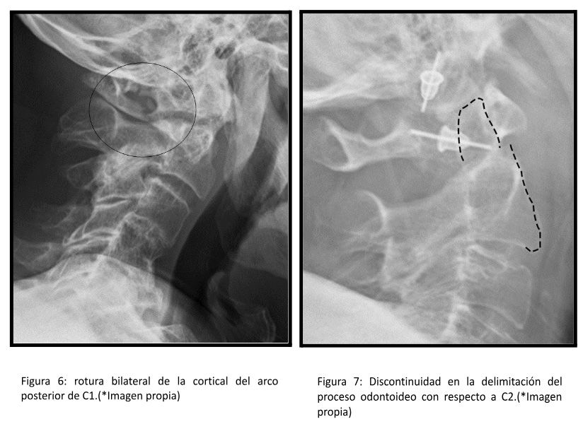 ejemplo radiografías fracturas c cervical