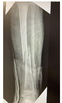 fractura diafisaria tibia peroné
