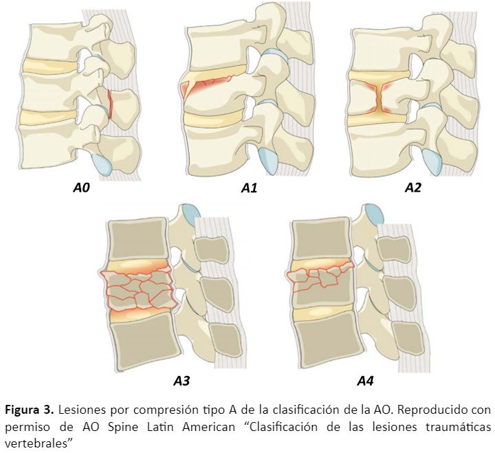 lesiones compresión tipo b